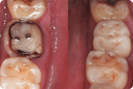 До: Протезирование зубов и виниры