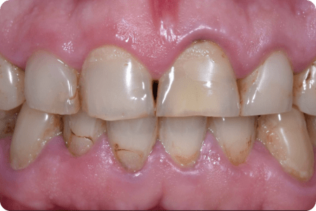 До: Протезирование зубов с уровня имплантатов