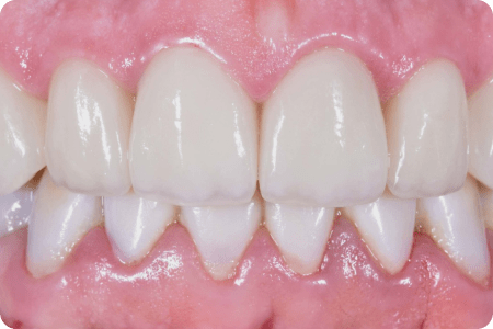 После: Протезирование зубов с уровня имплантатов