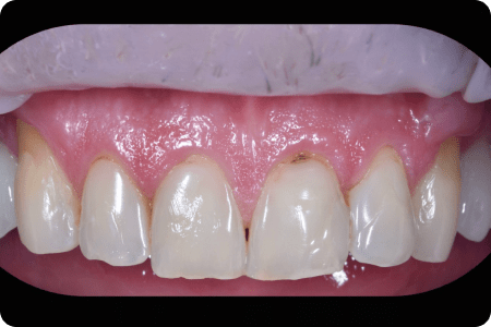 До: Протезирование зубов