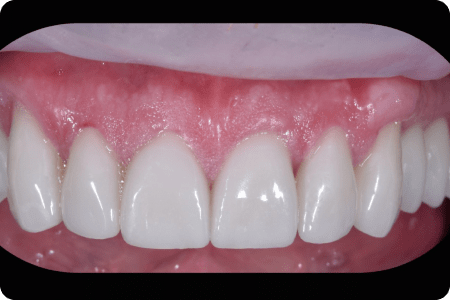 После: Протезирование зубов