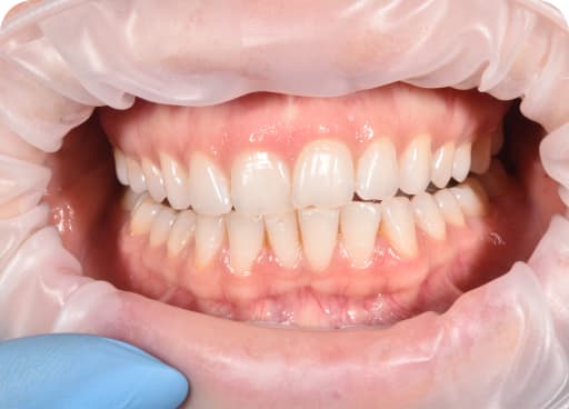До: Эстетическая и функциональная реконструкция зубов