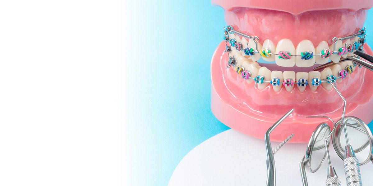 Импланты для ортодонтической коррекции прикуса подросткам