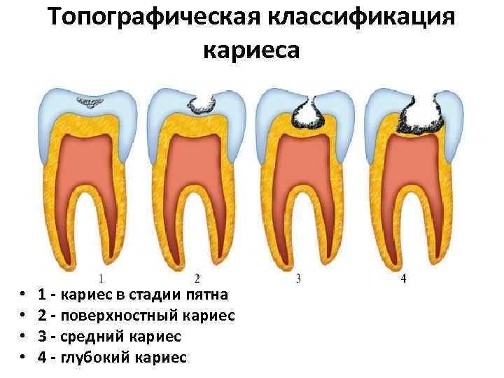 Памятка после лечения кариеса