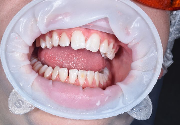 Комплексная гигиена полости рта при гингивите средней степени