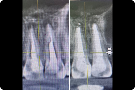 До: 2 Эндодонтическое перелечивание корневых каналов зубов