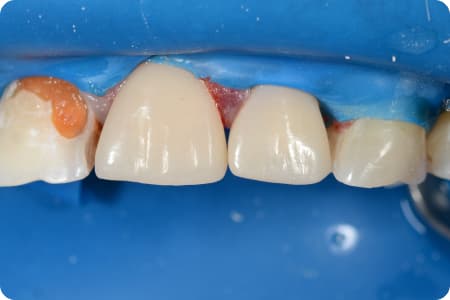 После: Реставрация зубов