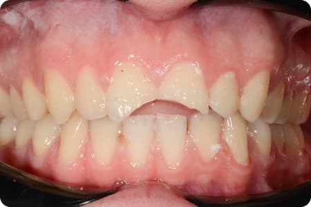 До: 5 Художественная реставрация зубов