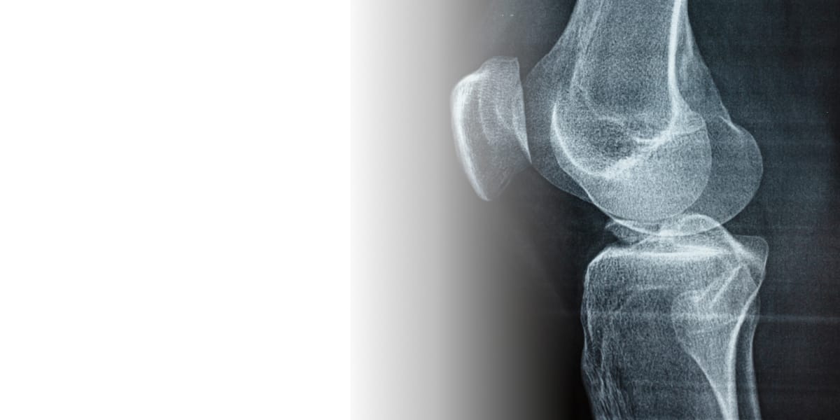 КТ суставов