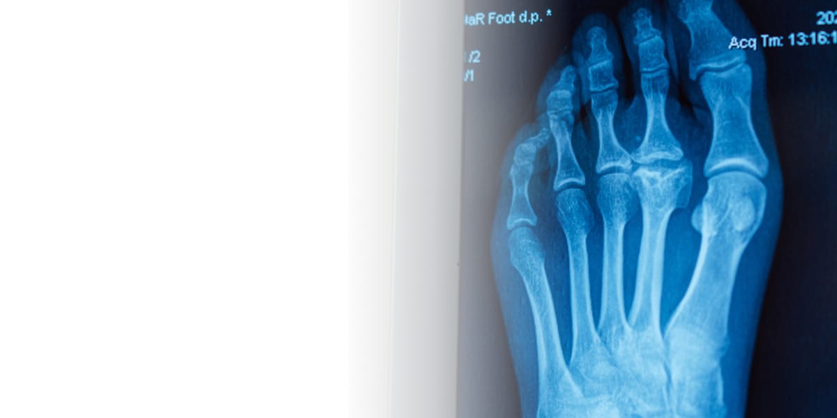 Компьютерная томография стопы